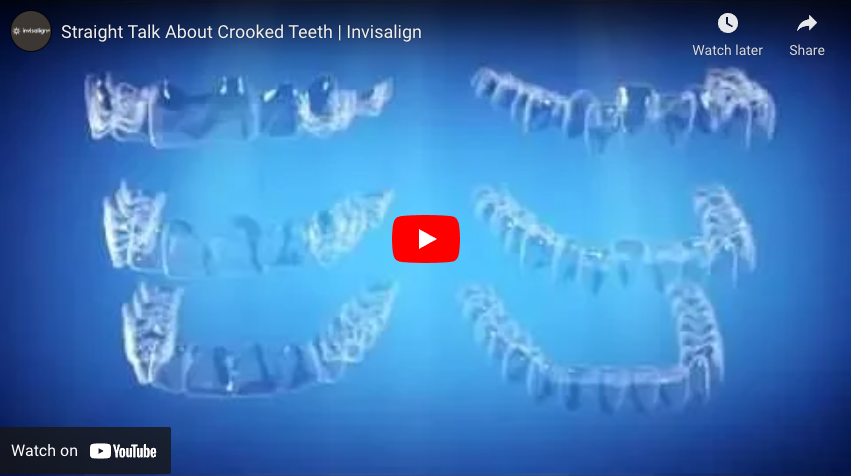 Clear Aligners